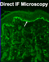 - Direct Immunofluorescence shows linear deposits of IgG and C3 along the Basement Membrane Zone (same as for Bullous Pemphigoid)
- Indirect Immunofluorescence shows linear staining of epidermal, dermal and epidermal, or just dermal (in case of a...