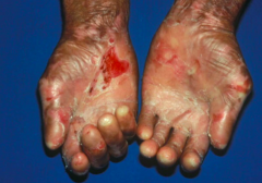 What kind of diagnostic tests are done to confirm Epidermolysis Bullosa Acquisita?