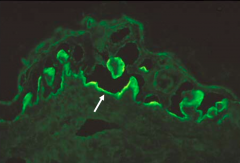- Direct Immunofluorescence shows deposits of IgG and C3 along Basement Membrane
- Indirect Immunofluorescence shows staining of dermal side of salt-split skin
- ELISA not available