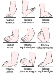 1-which bowing is physiologic? 
2-if PM bowing what is the assoc condition that affects the foot
3-MC  sequelae of posteromedial bowing is ___
4-apex of deformity is ___w/ calcaneovalgus foot deformity?