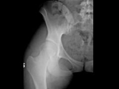 A 15-year-old soccer player complains of bilateral hip pain. The pain is worse with activity and she notices that she has fatigue and pain that extends to the thighs and knees following a soccer match. She is nontender at the pubis symphysis and h...