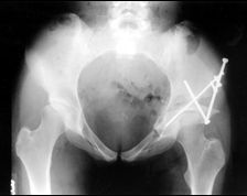 The clinical presentation is consistent with DDH in a patient with a closed triradiate cartilage. A peri-acetabular osteotomy (Ganz) is the most appropriate treatment.

The peri-acetabular osteotomy (Ganz) is a reconstructive osteotomy for DDH p...
