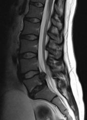 The clinical presentation is consistent for a lumbar disc herniation with symptoms of a combined L5 and S1 radiculopathy that has failed to improve with extensive nonoperative treatment. At this time a discectomy would lead to the greatest improve...