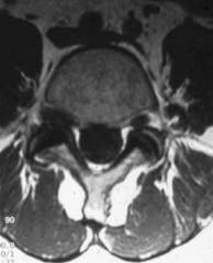 the Wiltse paraspinal approach is ideal, which preserves segment stability by avoiding injury to the lamina and facet joints. The clinical presentation and MRI images demonstrate a right-sided far lateral disc herniation at L4/5. As opposed to a p...