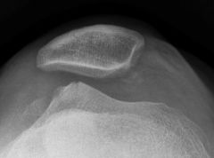 Reflex Sympathetic Dystrophy (RSD) of the knee is different than that of the upper extremity. Pain out of proportion to the initial injury is the hallmark symptom. Other features include vasomotor disturbances, delayed functional recovery and vari...