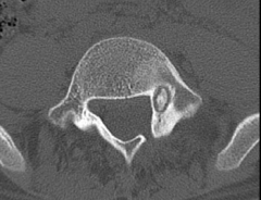 A 27-year-old male presents with an acute onset of low back and right leg pain following a water skiing accident two weeks ago. His physical exam shows no neurological deficits. Lumbar spine radiographs are normal. An axial and coronal CT scan are...