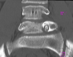 xray findings are consistent with an osteoid osteoma. This lesion is likely an incidental finding, and not likely to be causing the patients symptoms. Continued clinical observation is the most appropriate treatment. Considering the patient has a ...