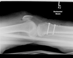 A 24-year-old female has moderate arthrosis of the medial facet of the patella and the medial femoral condyle. Which of the following procedures is contraindicated?  
1.  Anterior (Maquet) tibial tubercle osteotomy 
2.  Anteromedial (Fulkerson) ...