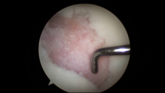 A 32-year-old female is referred to you for definitive treatment of a symptomatic focal chondral defect on her medial femoral condyle. A photograph from a recent diagnostic arthroscopy shows the defect (Figure A), which measured 20 x 25mm after de...