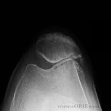 Joint space narrowing on a merchant view is a CI for autologous chondrocyte implantation for patellofemoral arthritis.
 ACI relies on intact, full-thickness cartilage margins to maintain the joint space so that the growing cartilage repair tissue...