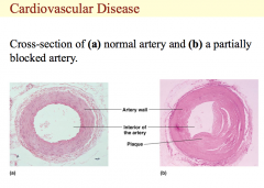 Cross-section of (a) normal artery and (b) a partially blocked artery.
This illustration shows a normal artery on the left.  The opening in the artery is wide and clear allowing normal blood flow.  On the right is a partially blocked artery that ...