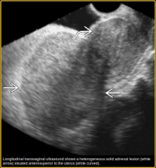 Describe this lesion arising in the left adnexa and list differentials