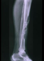 An 28-year-old male presents for evaluation of leg pain. He denies trauma, and is otherwise healthy. A lateral radiograph of the affected leg is shown in Figure A. A biopsy is taken, and the low and high power histology specimens are shown in Figu...