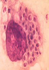 Identify from direct exam
A.Histoplasma capsulatum
B.
C.Coccidioides immitis
D.Rhodotorula rubra