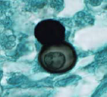 Identify from direct exam
A.Rhodotorula rubra
B.Coccidioides immitis
C.Histoplasma capsulatum
D.Blastomyces dermatitidis