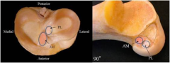isolated deficiency of the AM or PL bundle of the ACL on the resulting knee kinematics.  transection of the anteromedial bundle leads to increased anterior tibial translation at 90 degrees of knee flexion, whereas transection of the posterolateral...
