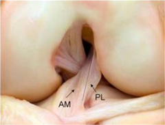 Isolated transection of the posterolateral(PL) bundle of the ACL has what effect on anterior tibial translation and rotatory stability of the knee?  
1.  Increased tibial translation and rotation at 30 degrees of flexion 
2.  Increased tibial tr...
