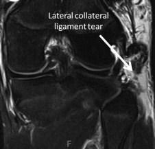 (LCL) and (PLC). The LCL is part of the posterolateral corner, but can be injured in isolation or along with the rest of the  An isolated LCL tested by flexing the knee at 30 & applying varus stress. PLC can be tested by the dial test, which is do...