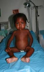 Kwashiorkor is protein deficiency. It effects mainly developing countries because of limited money and overpopulation