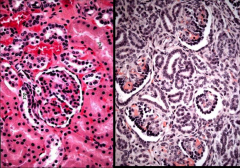 RENAL TUBULAR DYSGENESIS. Compare to normal.

Note that you can't see any proximal convoluted tubule in renal tubular dysgenesis.