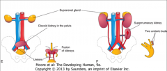 Fusion: Pelvic (discoid, horseshoe) kidney.

Two buds: Supernumerary kidney.
