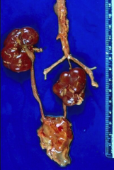 Pelvic Kidney
