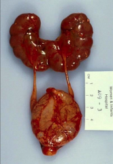 Horseshoe Kidney
*associated with higher incidence of Wilms tumor.