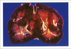 *FUSED KIDNEY (in horseshoe kidney).
*Affects about 1:500. You can live with this.