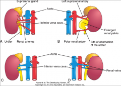 *Additional artery is a frequent occurrence. Usually of no significance.
*25% of adult kidneys have more than one artery.
*Only 30% of adults have only one artery and one vein per kidney. 70% have LOTS of VARIATION.
*Anomalies more likely in ma...