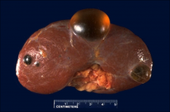 SIMPLE RENAL CYST