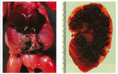 DIFFUSE CYSTIC DYSPLASIA:
*Kidneys are massively enlarged.
*Large number of tiny cysts bilaterally.