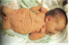 *PRUNE BELLY SYNDROME (ABDOMINAL MUSCLE DEFICIENCY SYNDROME).