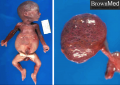 PRUNE BELLY SYNDROME; showing DIFFUSE CYSTIC RENAL DYSPLASIA.

*Key to remember: Diffuse Cystic Renal Dysplasia is UNCOMMON, and is associated with some syndromes; namely Meckel-Gruber and Prune Belly, some others.