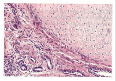 RENAL DYSPLASIA, showing poorly formed tubules surrounded by mesenchyme, and a large lobule (right) of cartilaginous tissue.