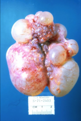*Prominent large cysts.
*Frequently unilateral.
*Minor dysplasia.
*Ureter may be absent, atretic, or stenotic.
*Bladder may be hypoplastic.
*May be associated with other anomalies.