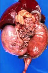 *AKA Infantile polycystic kidney disease.
*Early neonatal death.
*Greatly enlarged smooth kidneys with cylindrical cyst-like dilatation of tubules.
*Hepatic cysts and/or fibrosis may be present.
*Less severe forms are known, in which the child...