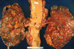 ADPKD. Enlarged cystic kidneys with multiple fluid-filled cysts.