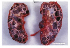 *AD POLYCYSTIC KIDNEY DISEASE.
*Walls of the cysts are smooth.