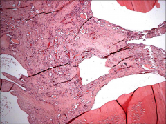 *ADPKD.
*Flat, pink material is protein in the center of the cysts.
*Extensive fibrosis in the actual renal tissue visible. It's also enflamed. It's becoming atrophic and non-functional.