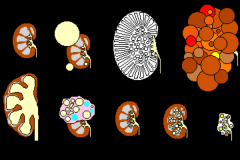 Summary of kidney cyst types:
