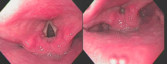 Upper GI Endoscopy
- Left shows hypopharynx during inhalation, esophagus is closed at bottom
- Right shows closed airway and opening of esophagus to swallow