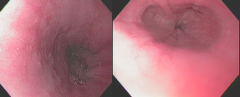 - Left: LES slightly open and gastroesophageal junction (Z line) visible
- Right: LES closed and GEJ (Z line) not visible