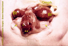 *Cloacal Exstrophy. 
*Note 2 hemibladders; as usual an omphalocele is present.
*Arrows point to hemivaginas.
*Asterisks indicate ileum and cecum.