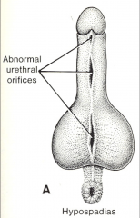 *Hypospadias represents a failure of fusion of the urogenital folds. As a result the urethra is open ventrally in one or more locations from the perineum to the glans.