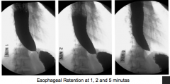 - Impaired relaxation of the LES (increased LES tone)
- Loss of peristalsis in body of esophagus