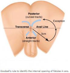 Openings in the skin anterior and within 3 cm of the verge track directly to the anal canal. Those posterior to the line or further than 3 cm will take a curved path and track to the posterior midline.