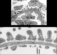 1: Endothelial surface with fenestrations.
2: BM.
3: Podocyte-projected foot processes. The slit diaphragm is between the foot processes.