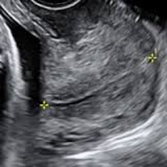 Ultrasound is used to evaluate cervical length during pregnancy to assess for _______ _______. 