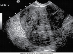 Is this uterus uniform in echogenicity? 

Are there masses suggestive of fibroids that may impede implantation of fertilized eggs? 