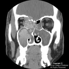CT findings
1) rim of hypointensity with hyperdense central material (allergic mucin)
2) speckled areas of increased attenuation due to ferromagnetic fungal elements

MRI findings
1) peripheral hyperintensity with central hypointensity on bot...